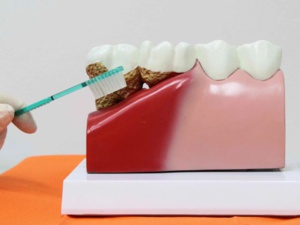 La prévention et le traitement des maladies parodontales