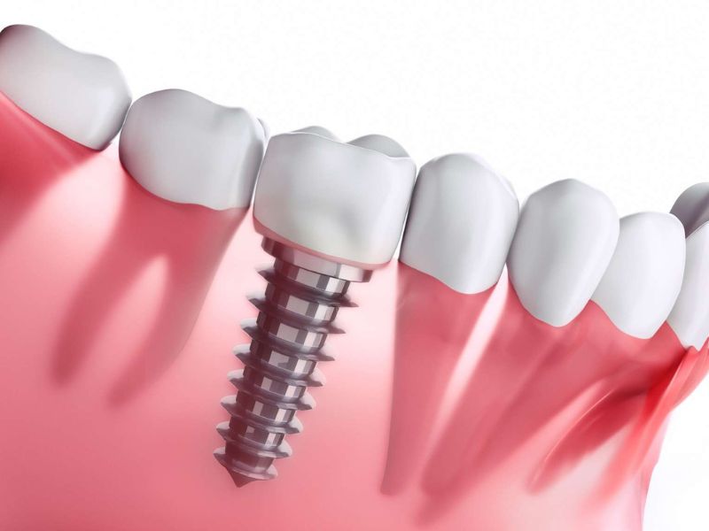 Les dernières innovations en implantologie dentaire