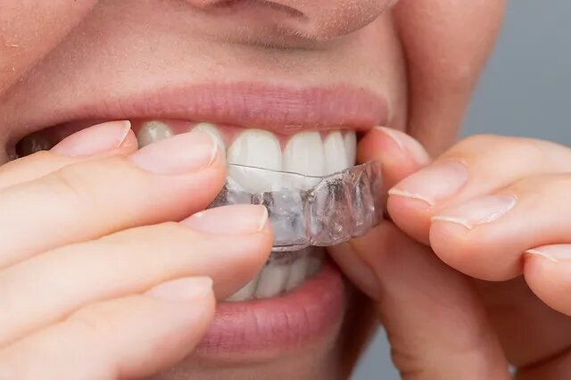 Les avancées en orthodontie invisible