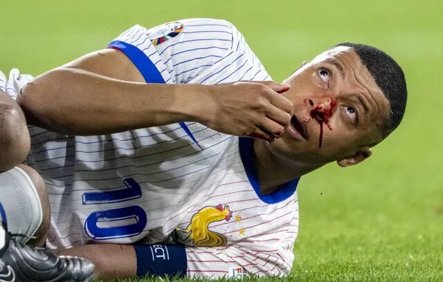 ​Euro-2024 : Mbappé Évite le Bloc Opératoire et Prépare Son Retour avec un Masque Protecteur"