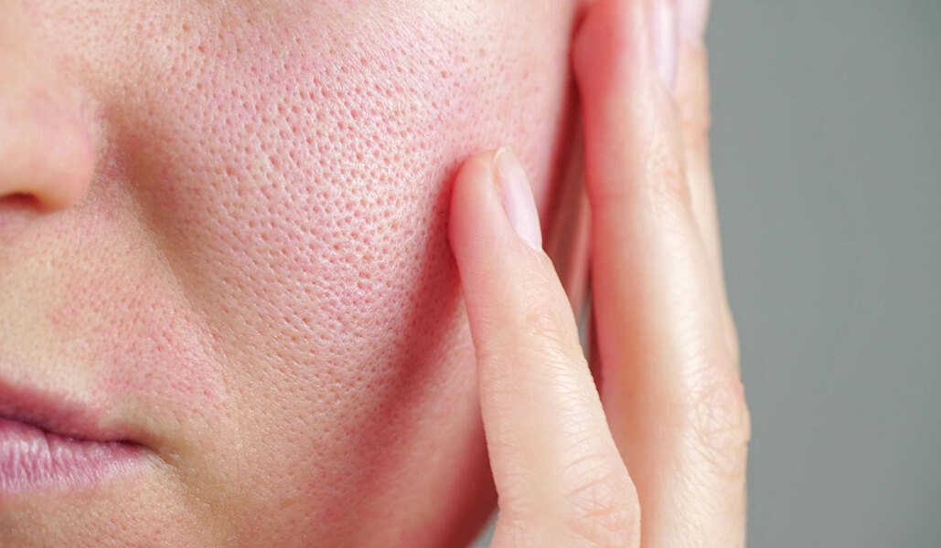 Essayez ces deux soins maison efficaces contre les pores dilatés