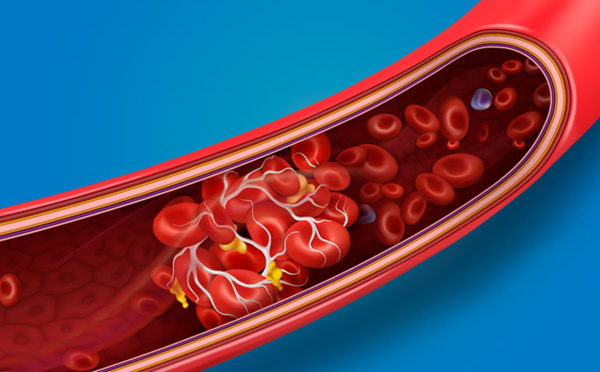 Pourquoi la Covid-19 entraîne-t-elle des thromboses ?