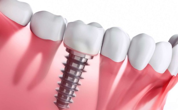 Les dernières innovations en implantologie dentaire