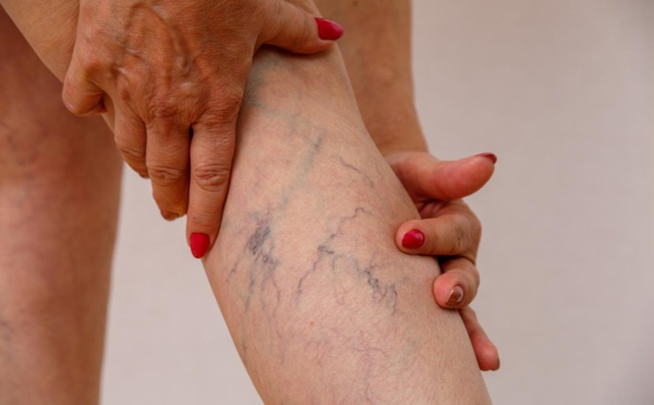 Les varices : plus qu'une simple déformation veineuse