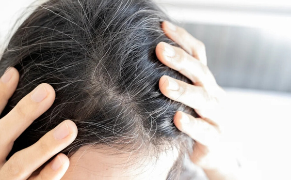 Pourquoi les cheveux blancs apparaissent-ils plus tôt chez les jeunes ?