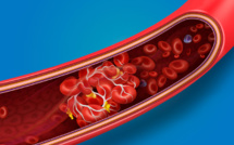 Pourquoi la Covid-19 entraîne-t-elle des thromboses ?