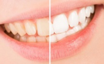  Comment blanchir ses dents sans les abîmer ?