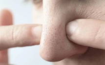 Comment se débarrasser des points noirs sur le nez		